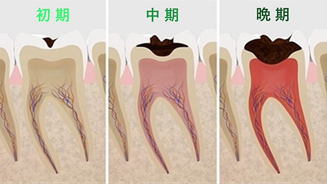 むし歯