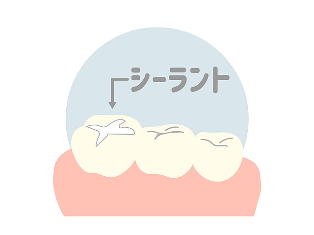 シーラント